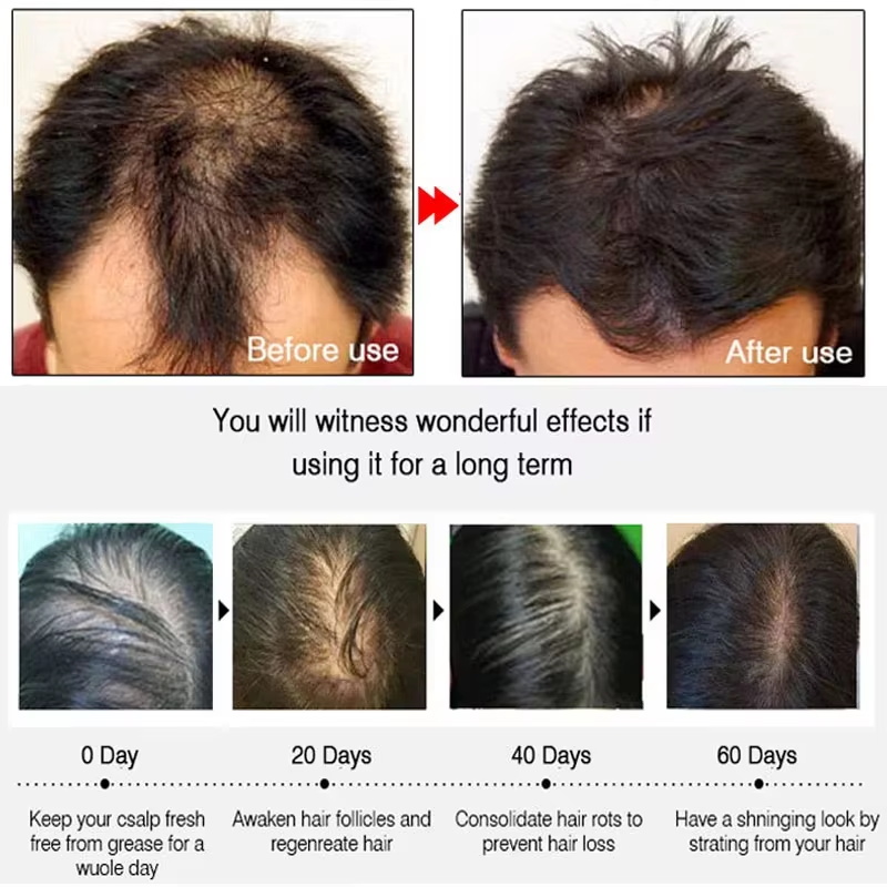 速効性ジンジャーヘアグローススプレー、毛根育成、脱毛防止、育 - Hair Care Oil Serum のレビューと価格
